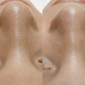 Маска 3 в 1 для удаления черных точек BIOAQUA Three Step Curved Nasal Mask For Removing Blackheads And Shrinking Pores